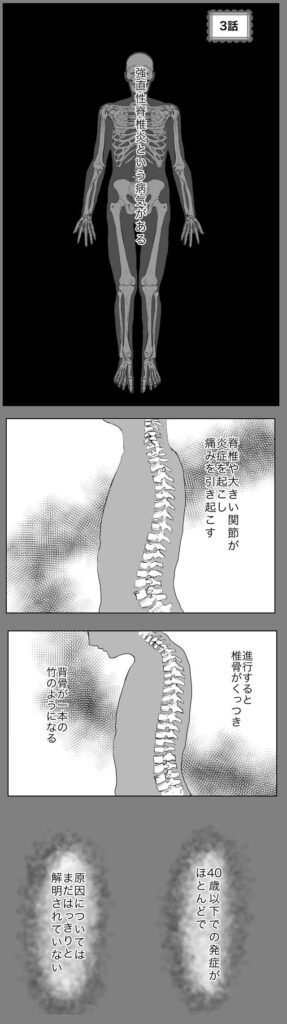 強直性脊椎炎という病気がある。この病気は脊椎や大きな関節が炎症を起こし痛みを伴う。進行すると椎骨がくっつき、背骨が一本の竹のようになる。